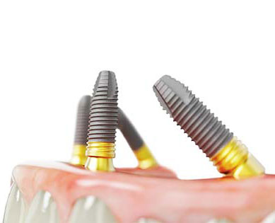 All-on-4-Implantatsystem