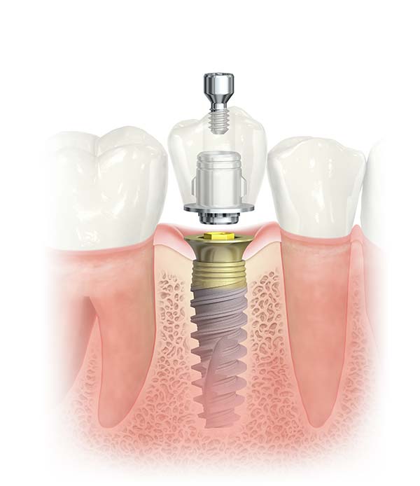 Implantat IKM
