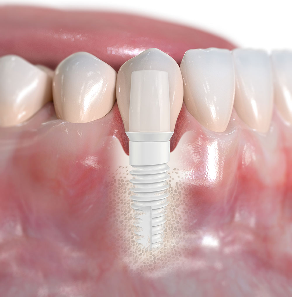 Keramikimplantat Nobel Pearl